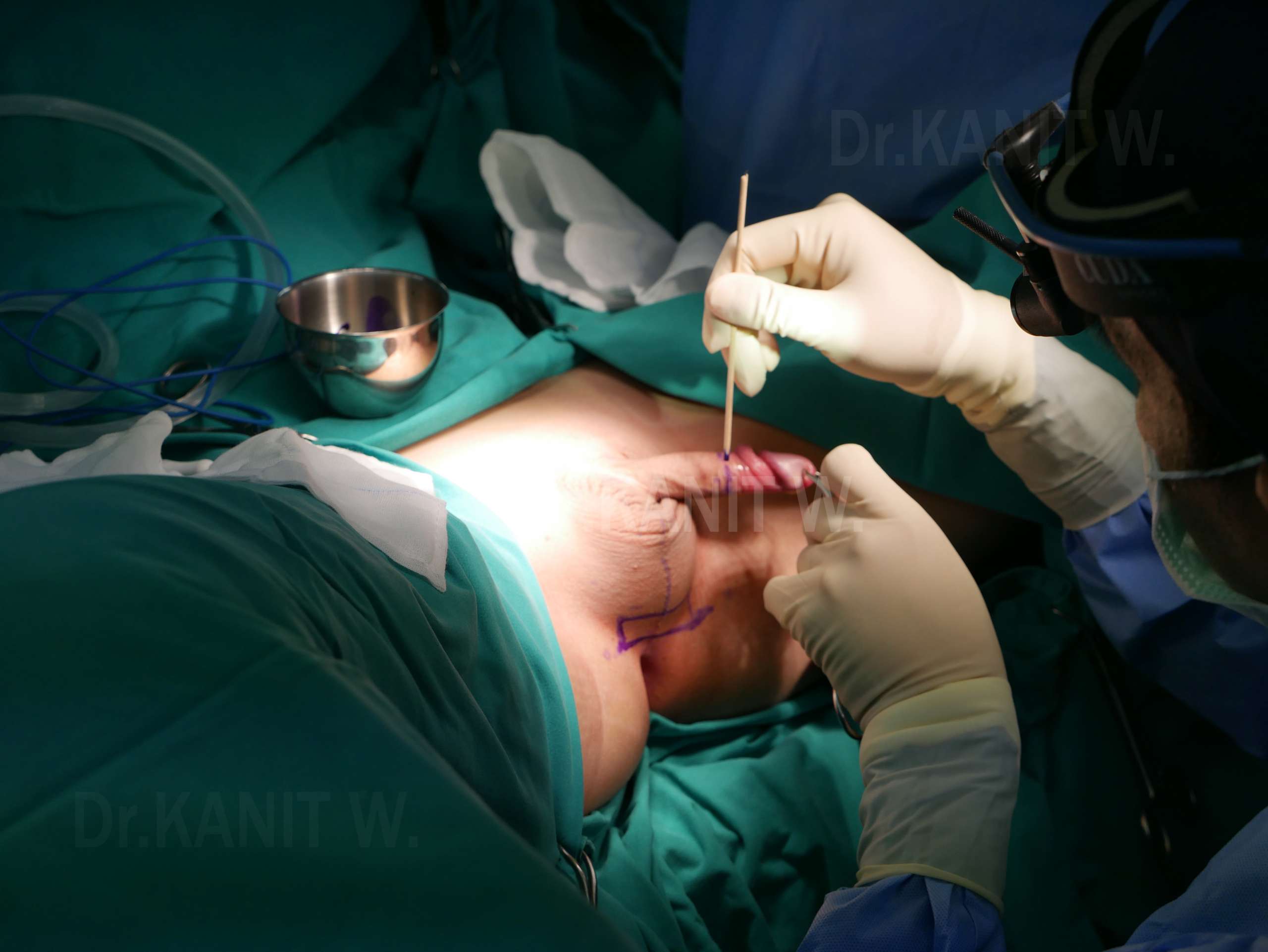 sexchange surgery in thailand