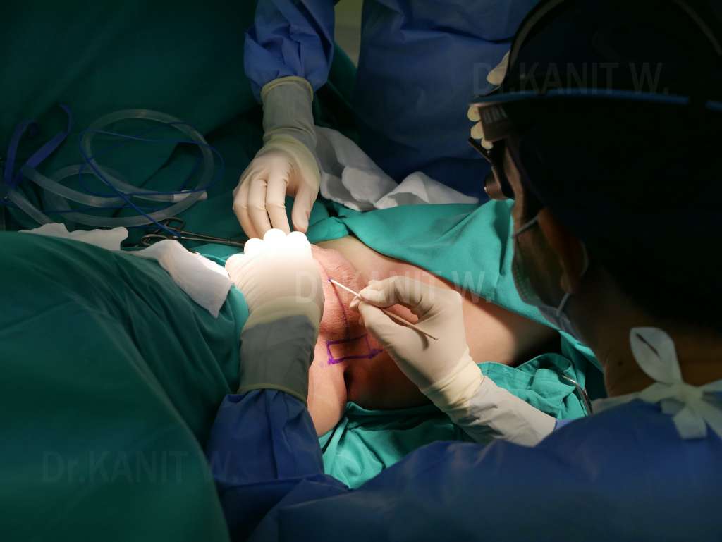 sexchange surgery in thailand